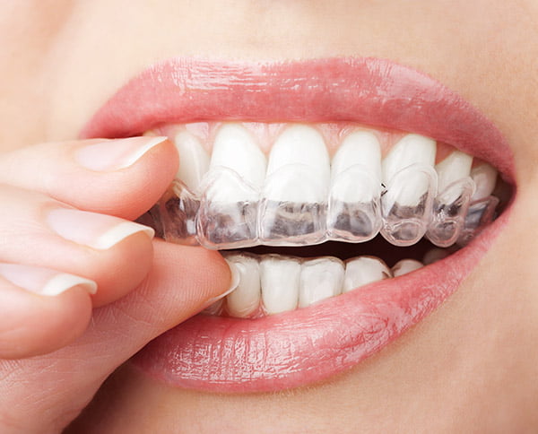 Invisalign® in London Ontario - Cosmo Dental Centre