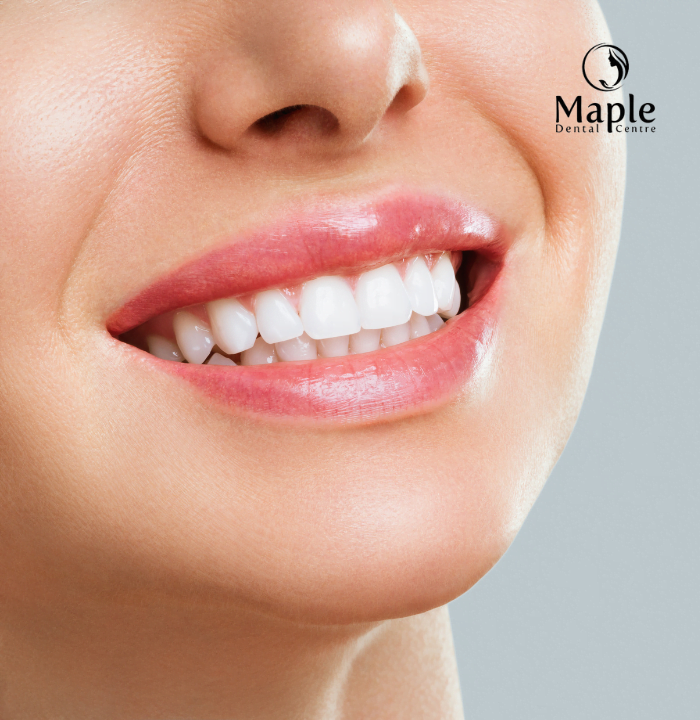 teeth whitening service in Maple