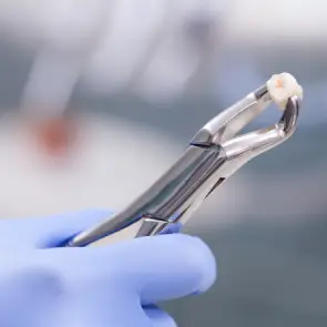 Tooth Removal