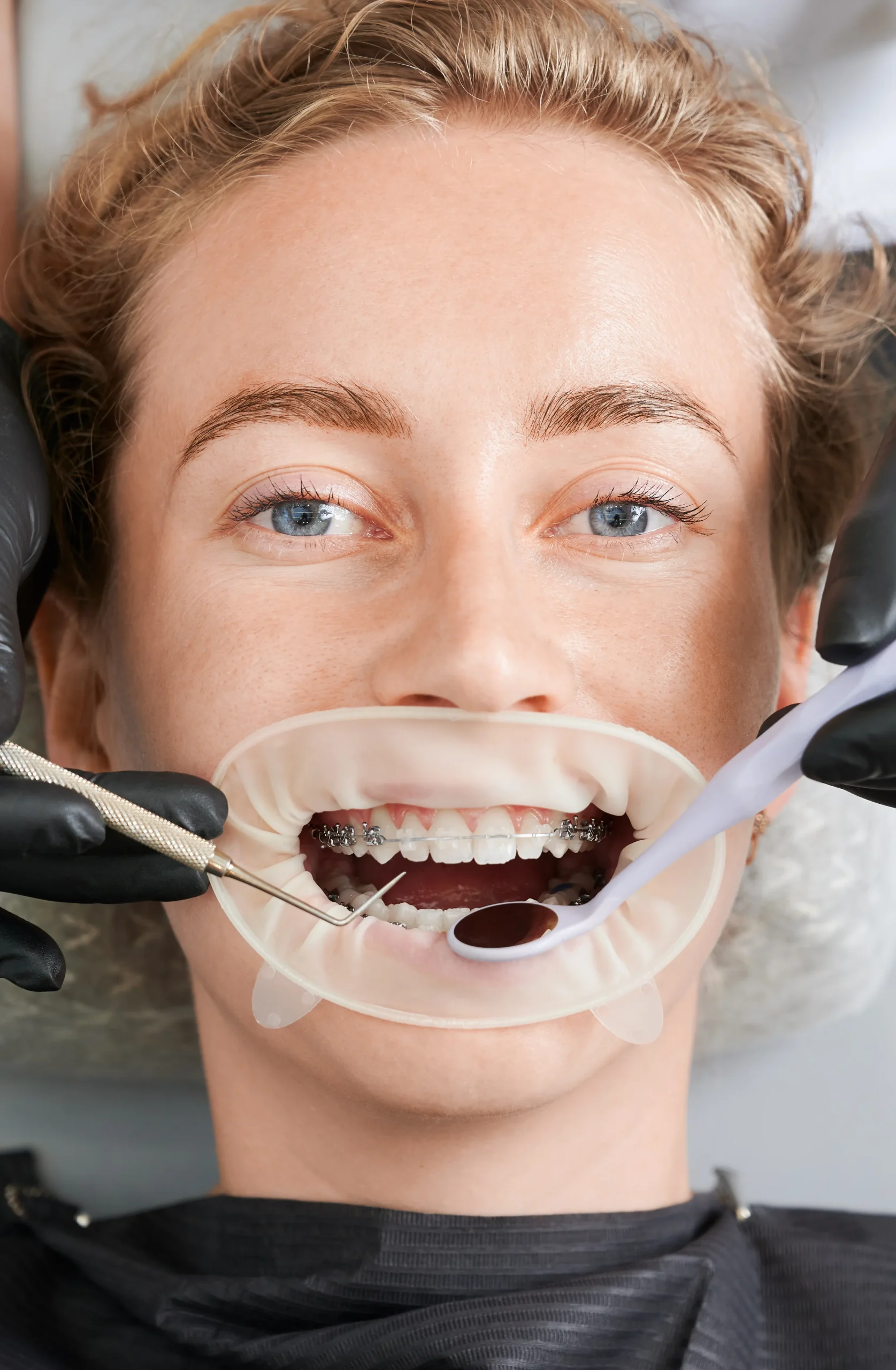 female-patient-with-braces-teeth-receiving-orthodontic-treatment